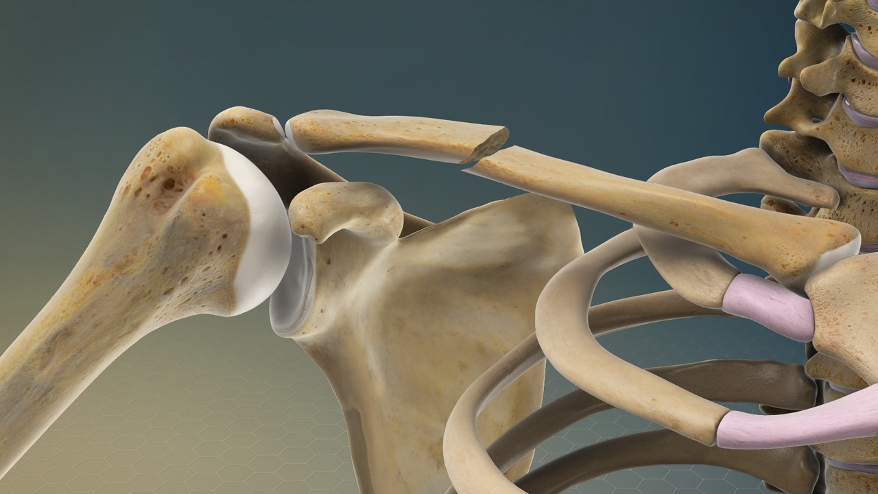 關於骨折的37個事實